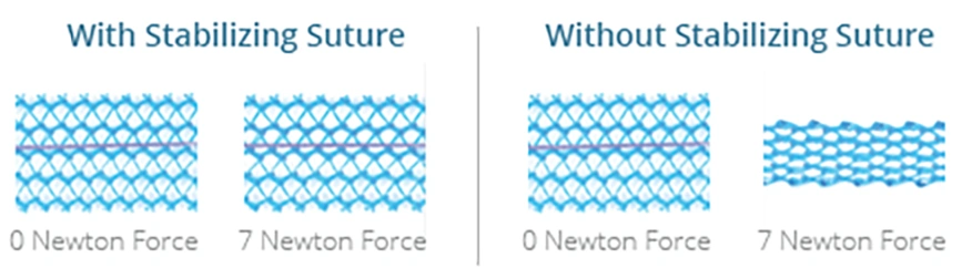 Stabilizing Suture